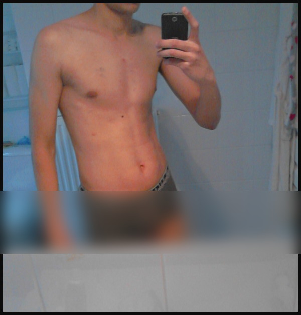 pectus excavatum